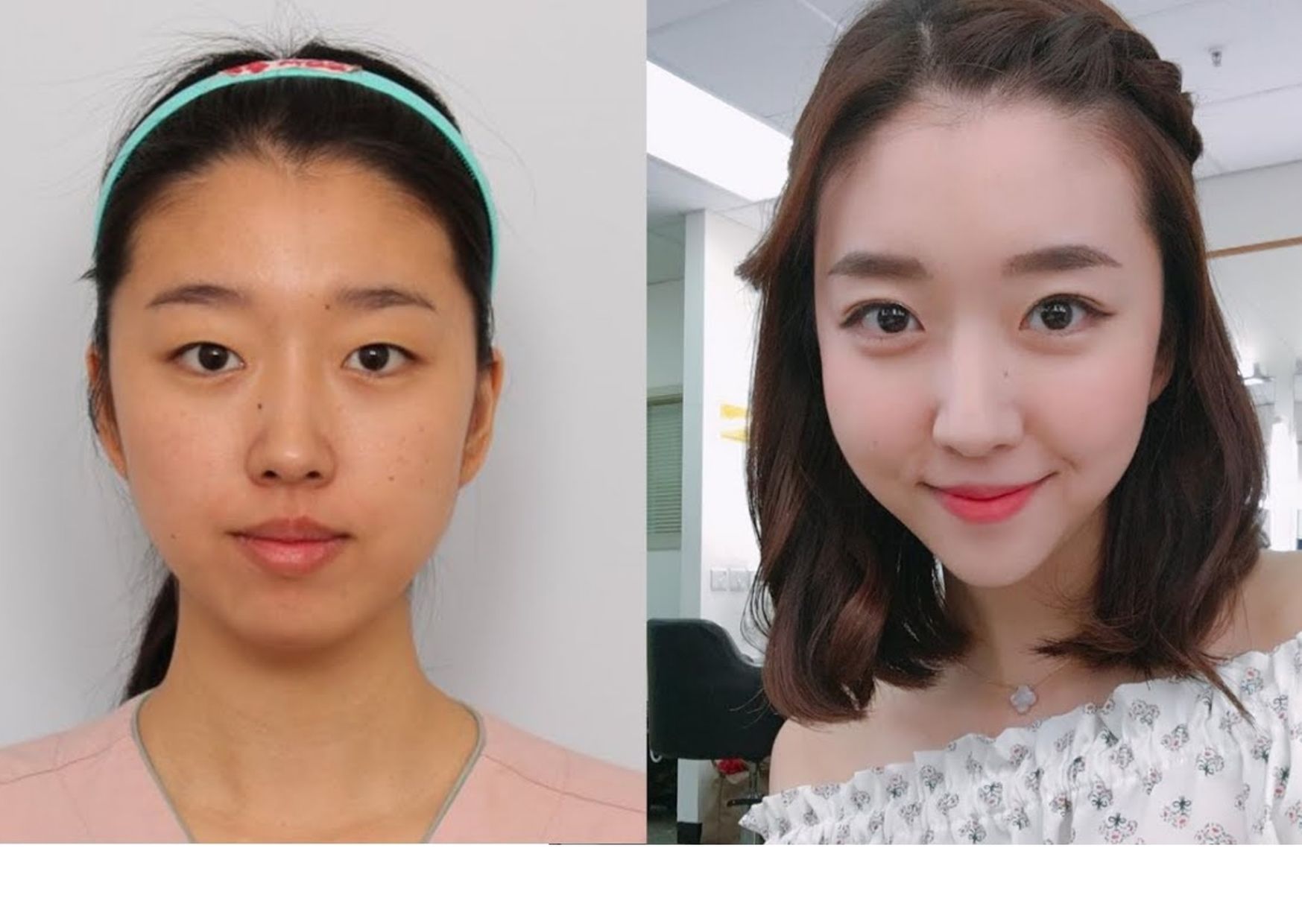 Sunny Dahye Sebelum dan Sesudah Operasi Plastik